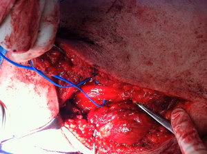 Hamstring Repair Sciatic Nerve 2