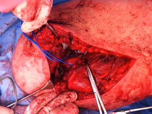 Hamstring Repair Sciatic Nerve