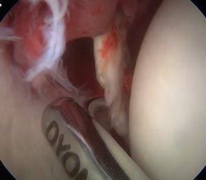 Hip Scope Loose Body