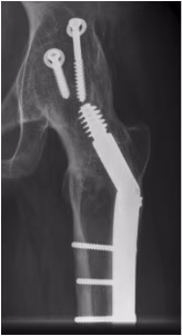 Hip Fusion 2