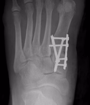 Hallux Valgus Lapidus Procedure