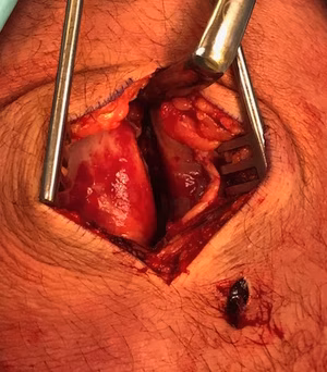 MPFL Patella Avusion