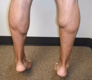 Medial Head Gastrocnemius Rupture