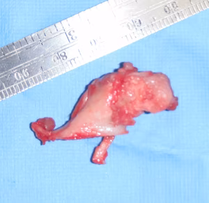 Osteochondroma Excised