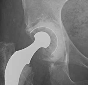 Revision Acetabulum Type IIIB
