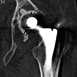 Revision THR CT scan Bone Defects