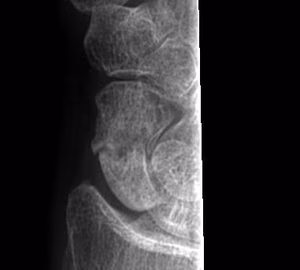 Scaphoid Nonunion Xray 2