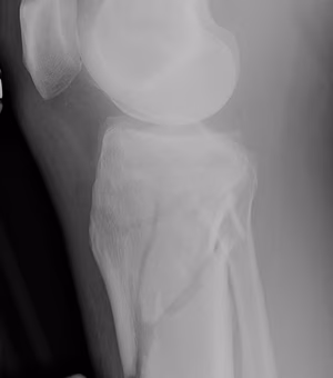 Tibial Plateau Temporary External Fixator Lateral