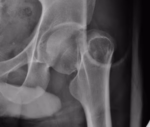 Subcapital Fracture Garden 4
