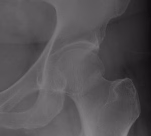 Subcapital NOF Garden 1 Xray