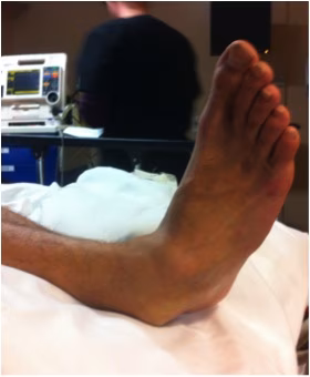 Subtalar dislocation 2