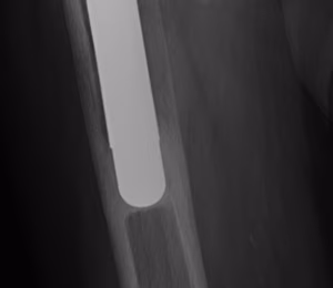 THR Uncemented Stem Spot Weld AP