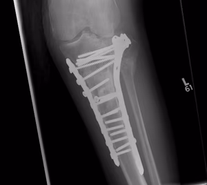 Tibial Plateau OA TKR0001