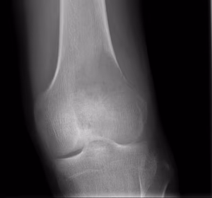 Bony Lesion Lateral Distal Femur