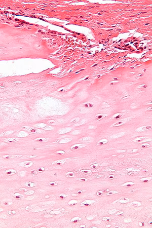 Enchondroma Nephron GNU Free Documentation License Version 1.3