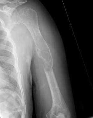 Metastasis Humerus Plate PMMA0001