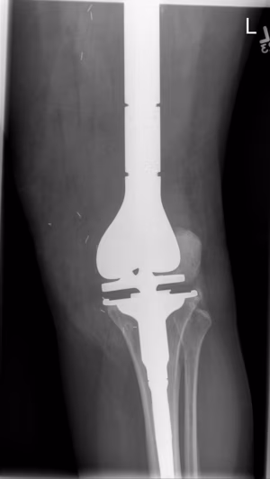 Osteosarcoma Distal Femur Tumour Prosthesis