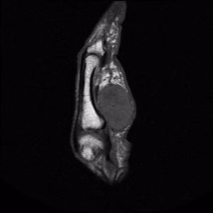 Sarcoma Hand0001