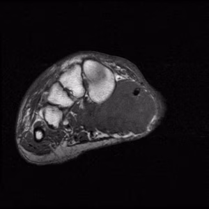 Synovial Sarcoma Foot MRI0002