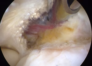 Arthroscopic Tennis Elbow Release 2