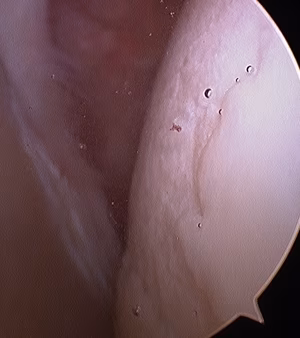 Arthroscopy Humeral Head OA