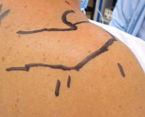 Shoulder Arthroscopy Posterior Portals