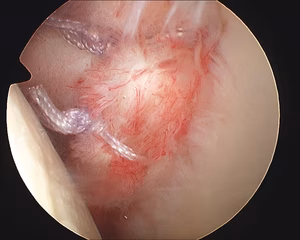 Arthroscopy Anterior Bankart Repair