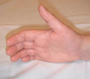 CRPS Hand