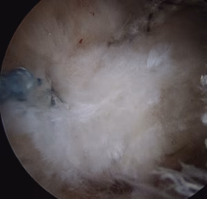 Calcific Tendonitis Arthroscopy 4