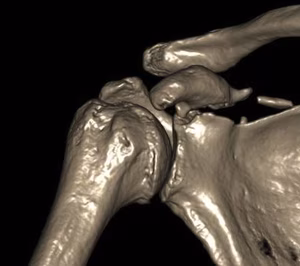 Coracoid Fracture CT 1