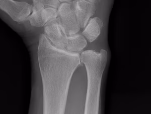 DRUJ Arthritis