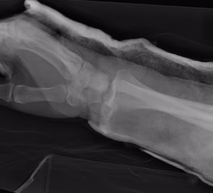 Dislocated Radiocarpal Joint