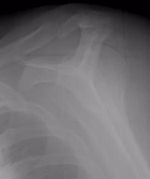 Displaced Greater Tuberosity Fracture Lateral