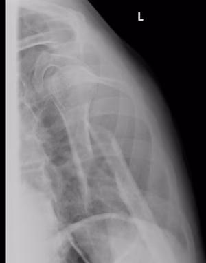 Displaced Humeral Fracture Lateral