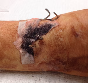 Distal Radius K Wires