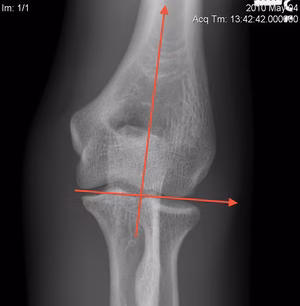 Elbow Normal AP 4 degrees valgus
