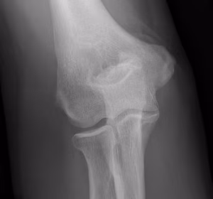Elbow OA AP