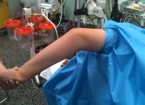 Elbow Malunion Preop