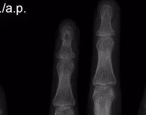 Epidermal Inclusion Cyst