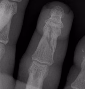 Finger Fracture Undisplaced