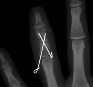 Finger Cross K Wires