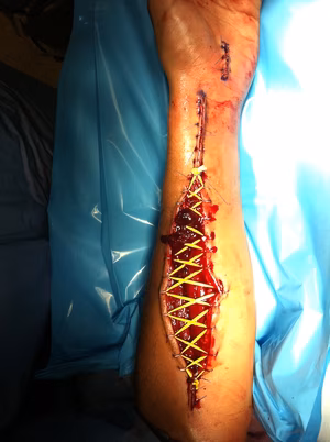 Forearm Fasciotomy Closure