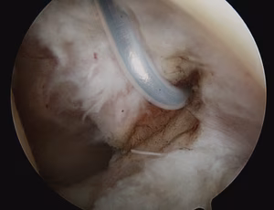 Frozen Shoulder MGHL Release