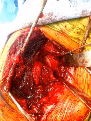 Glenoid Reconstruction Humeral Head
