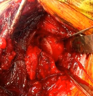 Glenoid Reconstruction