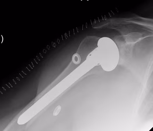 Hemiarthroplasty OA