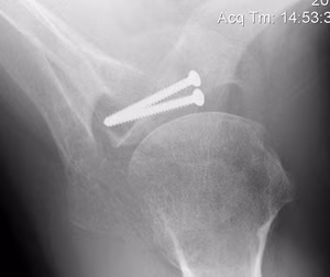Latarjet Axillary Lateral