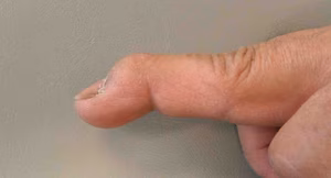 Mallet Finger