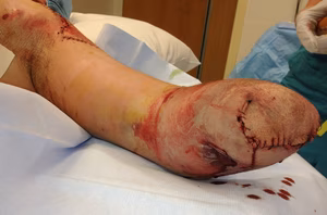 Forearm amputation