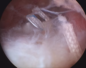Shoulder PASTA Repair Knots Tied Subacromial Space
